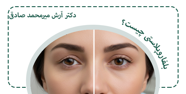 بلفاروپلاستی چیست