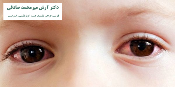 مشکللات بینایی کودکان