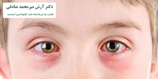 مشکللات بینایی کودکان
