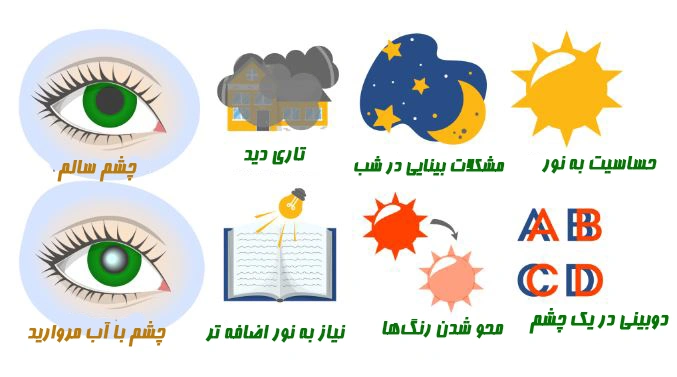 علائم آب مروارید چشم