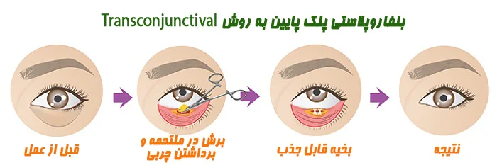 جراحی پلک پایین به روش Transconjunctival