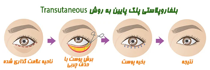 جراحی پلک پایین به روش Transcutaneous