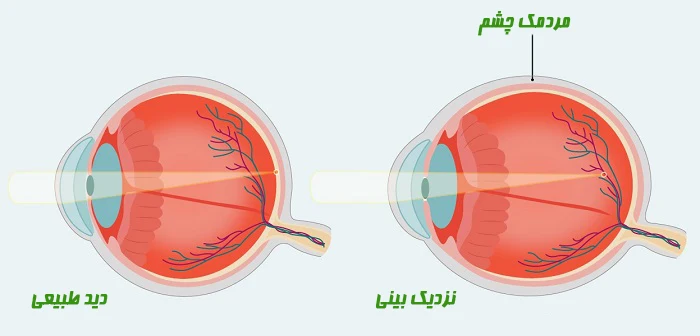 علت نزدیک بینی چشم در کودکان