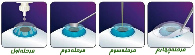 نحوه انجام عمل لازک