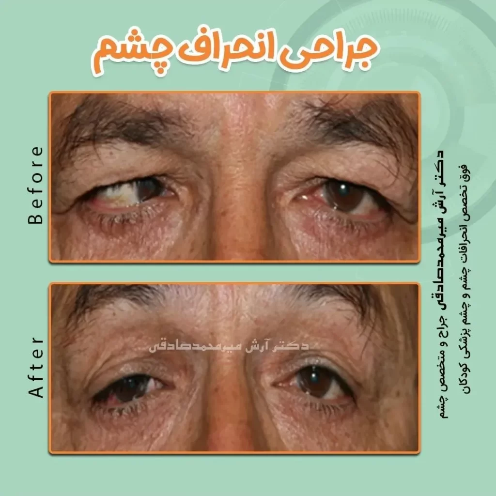 جراحی انحراف چشم در بزرگسالان