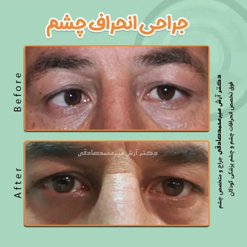 انحراف چشم در بزرگسالان