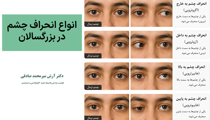 انواع انحراف چشم در بزرگسالان