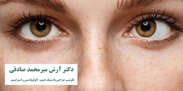درمان انحراف چشم
