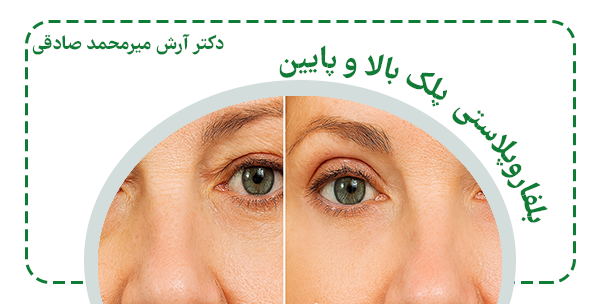 بلفاروپلاستی پلک بالا و پایین چیسن