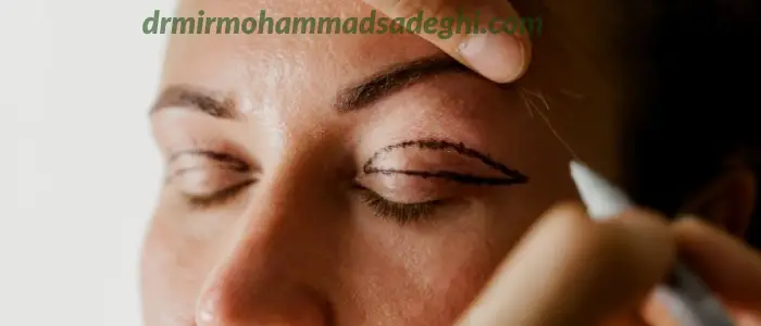 بلفاروپلاستی پلک بالا و پایین