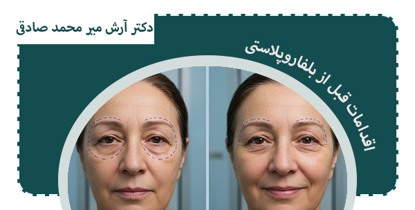 اقدامات فردی قبل از بلفاروپلاستی