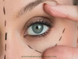آرایش چشم بعد از بلفاروپلاستی