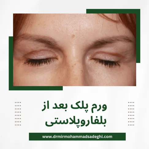ورم پلک بعد از بلفاروپلاستی
