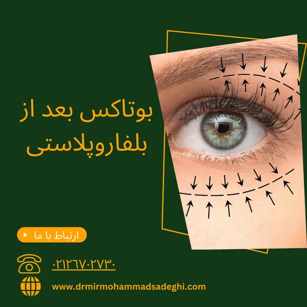 بوتاکس بعد از بلفاروپلاستی