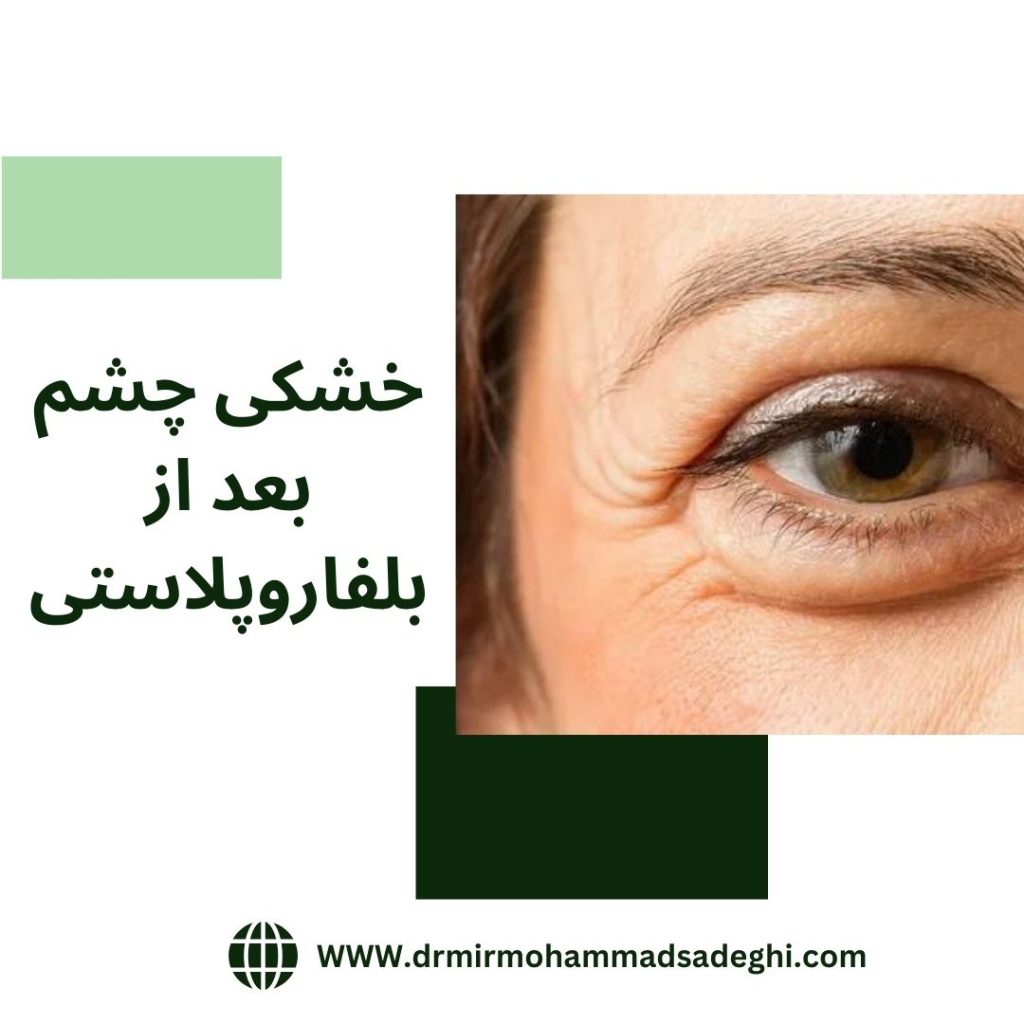 خشکی چشم بعد از بلفاروپلاستی