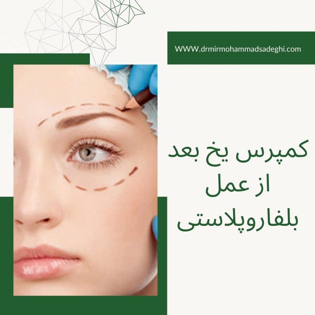 کمپرس یخ بعد از بلفاروپلاستی