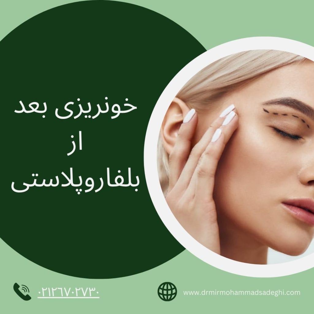 خونریزی بعد از بلفاروپلاستی