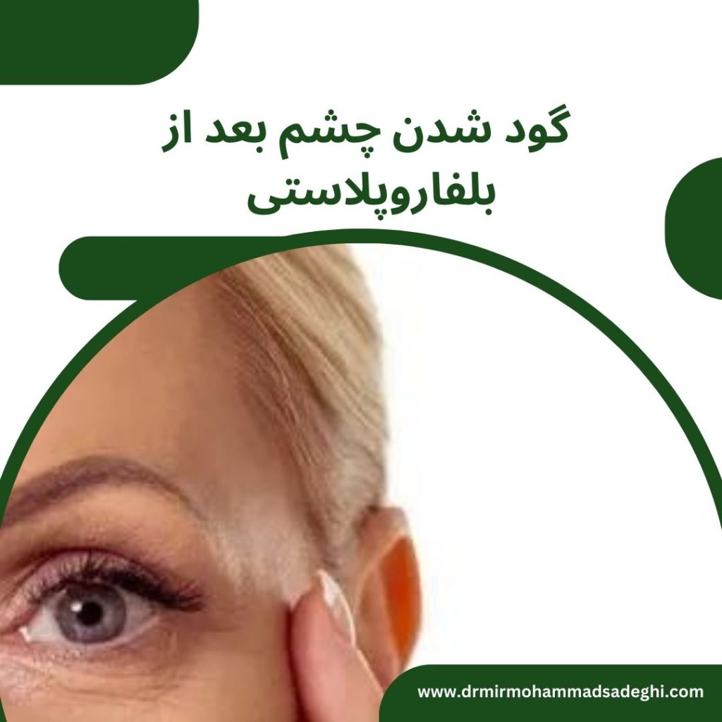 گود شدن چشم بعد از بلفاروپلاستی