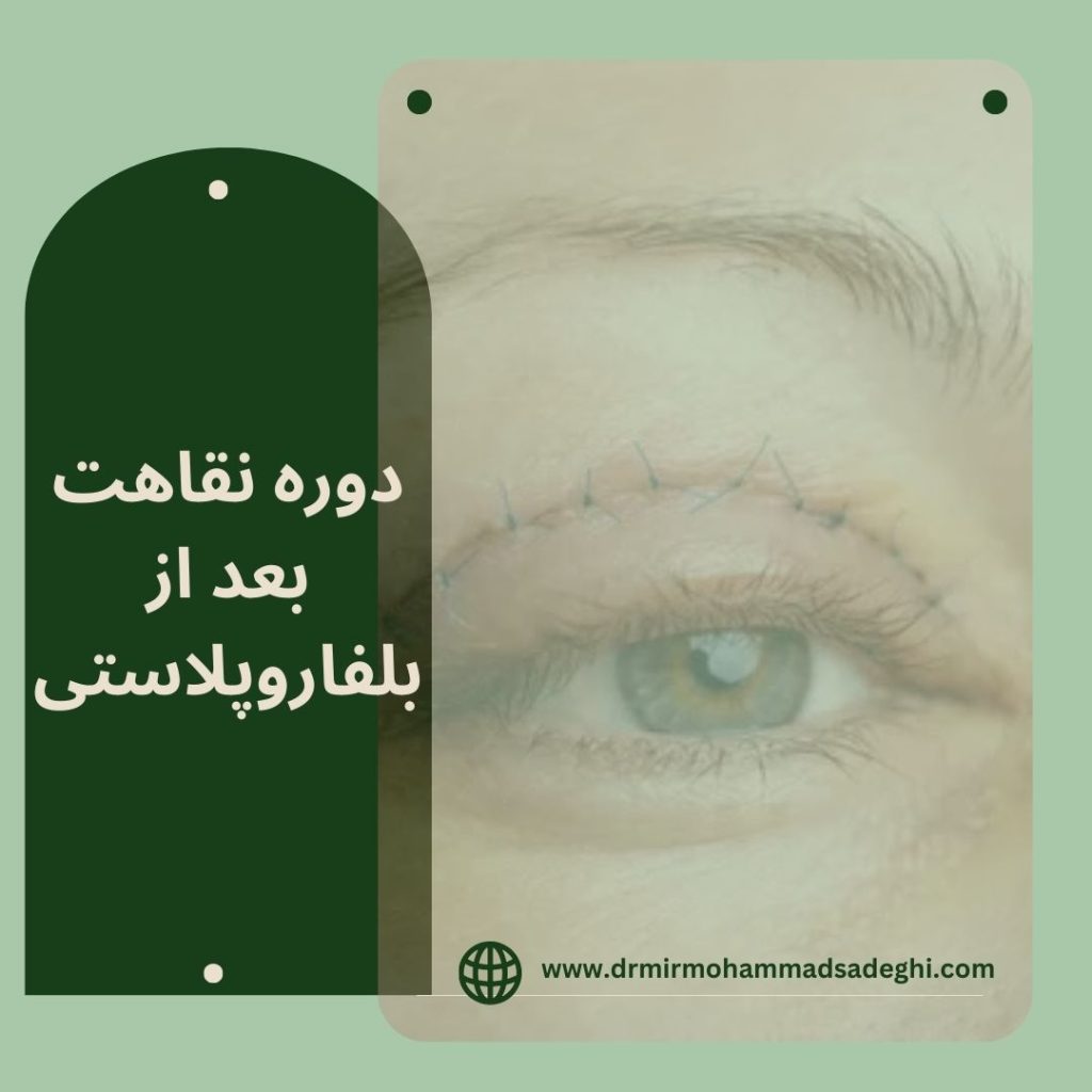 دوره نقاهت بعد از بلفاروپلاستی