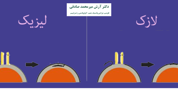 تفاوت عمل لیزیک و لازک