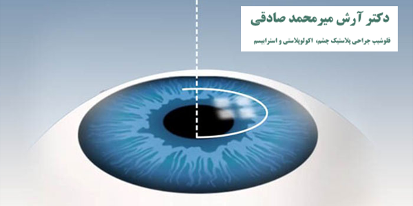تفاوت عمل لیزیک و فمتولیزیک