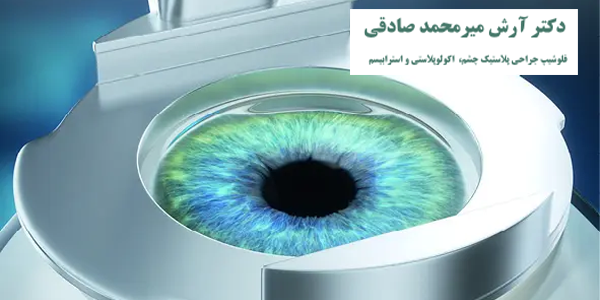 تفاوت عمل لیزیک و فمتولیزیک