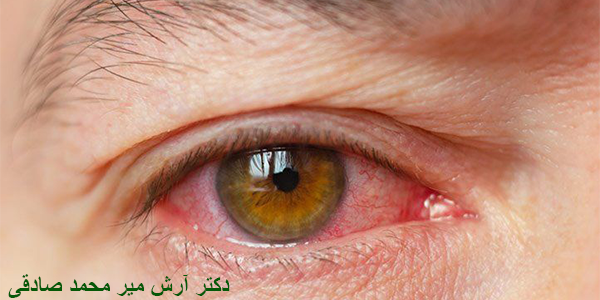 خشکی چشم و پیگیری