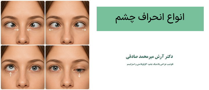 انواع انحراف چشم